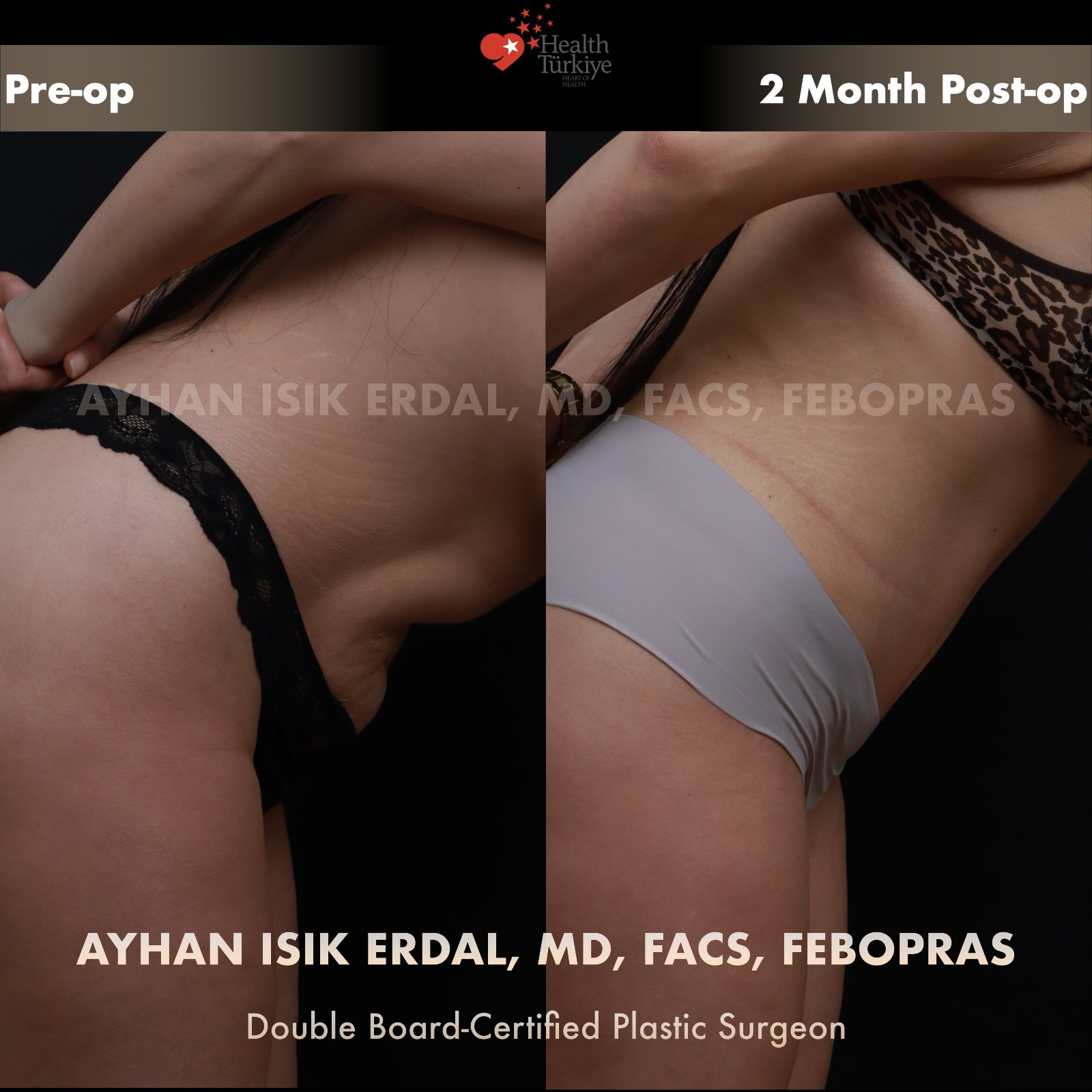 Standard abdominoplasty — dynamic / abdominal-lift comparison at 2 months post-op