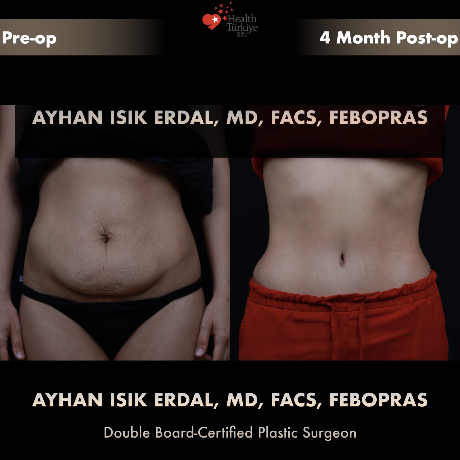 Post-partum standard abdominoplasty with striae excision — frontal comparison at 4 months post-op