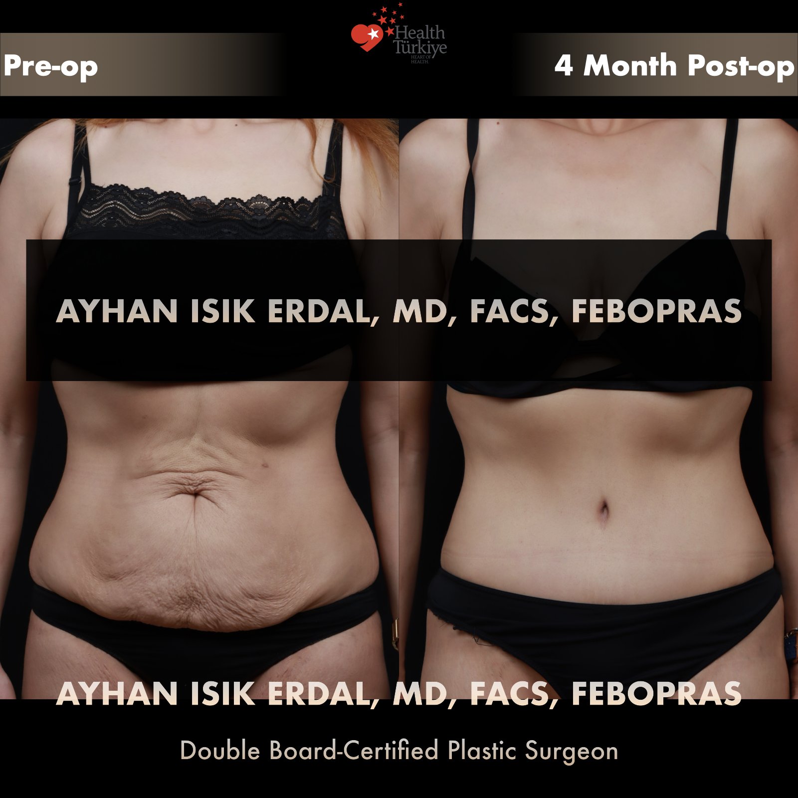 Standard abdominoplasty with significant skin laxity — frontal comparison at 4 months post-op