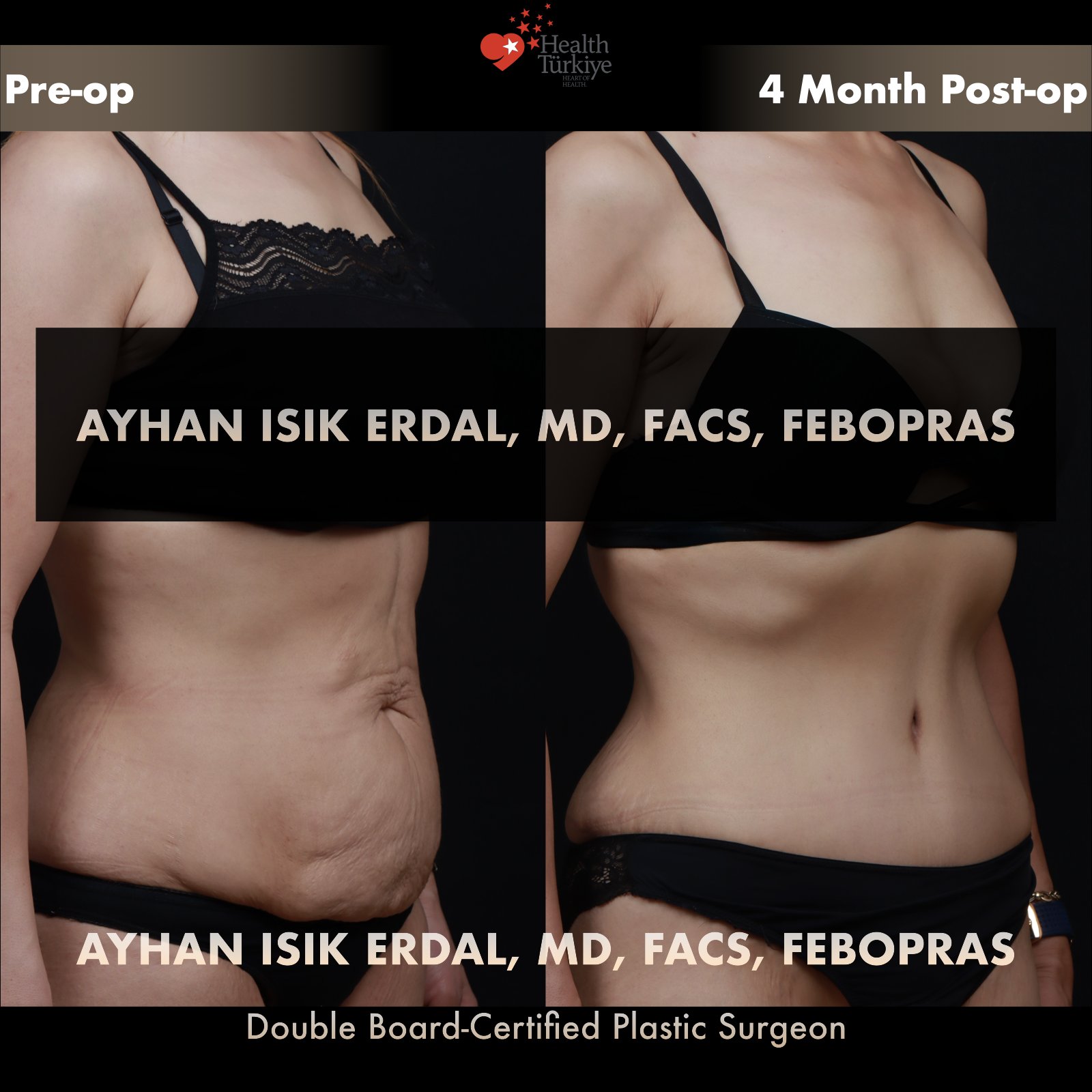 Standard abdominoplasty with significant laxity — oblique comparison at 4 months post-op